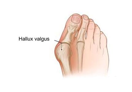 Illustratie hallux valgus bij grote teen