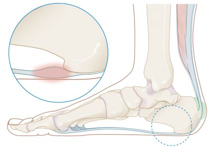 Medische illustratie hielspoor voet